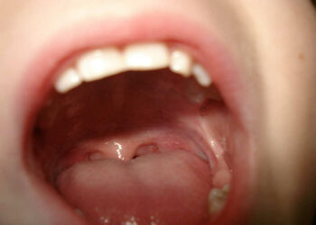 Lingua da Covid: strano sintomo della malattia