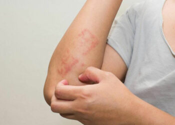 Psoriasi, croce per molti italiani