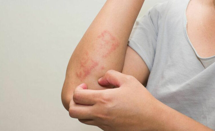 Psoriasi, croce per molti italiani