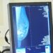 Tumore al seno: test genomici non ancora rimborsati