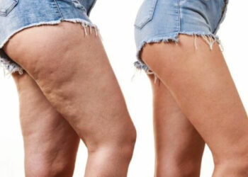 Criolisi o Criolipolisi contro cuscinetti grasso