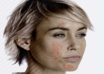 Rosacea, malattia cronica della pelle: effetti mascherina Covid