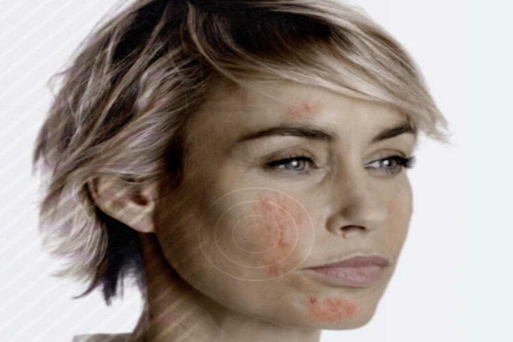 Rosacea, malattia cronica della pelle: effetti mascherina Covid