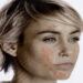 Rosacea, malattia cronica della pelle: effetti mascherina Covid