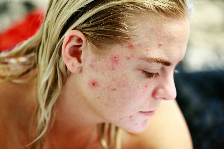 Acne e dieta, malattia della pelle: cosa mangiare e cosa non mangiare