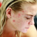 Acne e dieta, malattia della pelle: cosa mangiare e cosa non mangiare