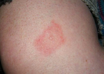 Malattia di Lyme, morso di animale: cos'è e sintomi