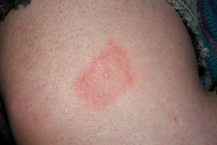 Malattia di Lyme, morso di animale: cos'è e sintomi