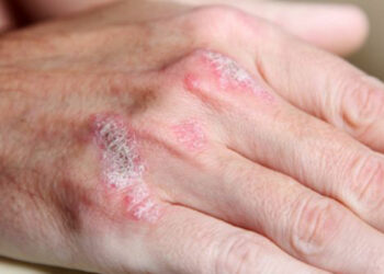 Artrite psorisiaca: sintomatologia articolare e clearance cutanea