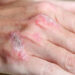 Artrite psorisiaca: sintomatologia articolare e clearance cutanea