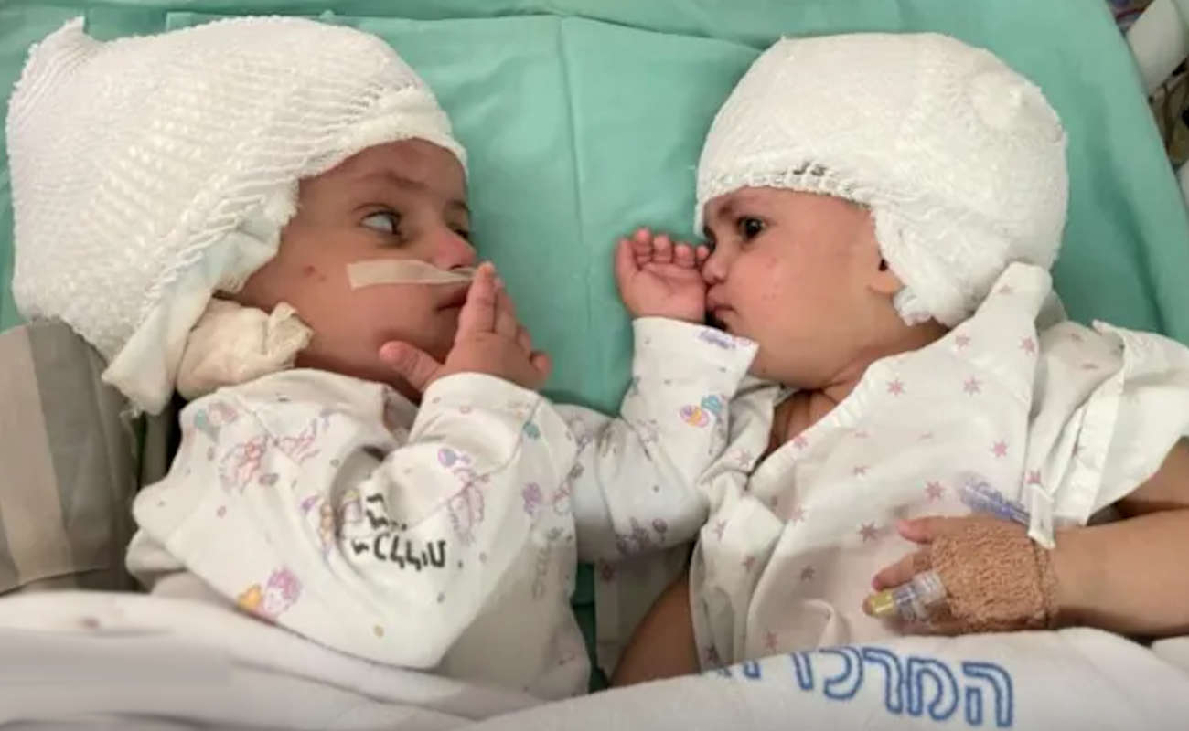 Coppia di gemelle separate dopo un anno VIDEO