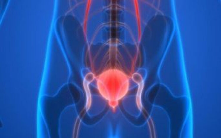 Carcinoma uroteliale, terapia con erdafinib e cetrelimab lo studio