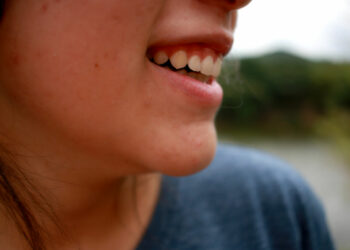 Ridurre i cibi ad alto indice glicemico per dire bye bye acne