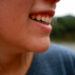 Ridurre i cibi ad alto indice glicemico per dire bye bye acne