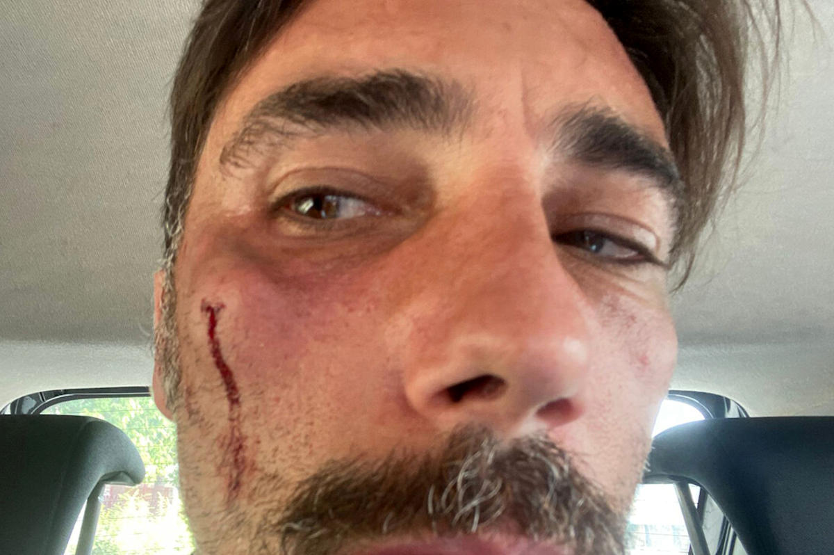 Vittorio Brumotti aggredito a San Severo, trauma facciale: 30 giorni prognosi VIDEO