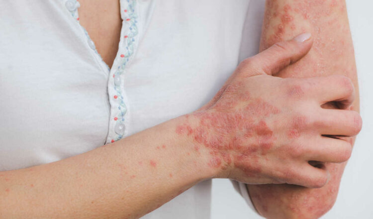 Psoriasi, malattia cronica della pelle: dermatologia e reumatologia per la cura