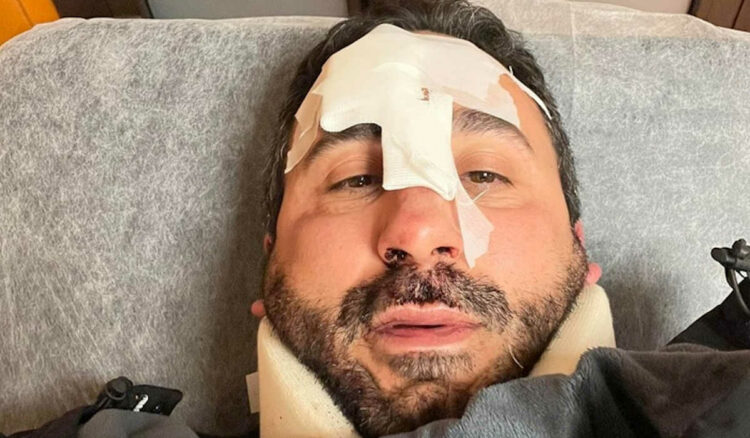 Lo chef della prova del Cuoco Natale Giunta i ospedale: cade con monopattino