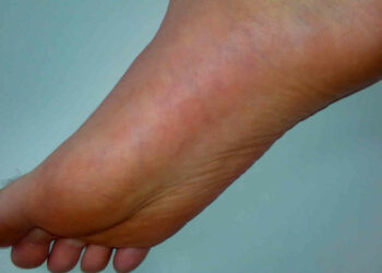 Colesterolo alto: attenzione a questi sintomi ai piedi