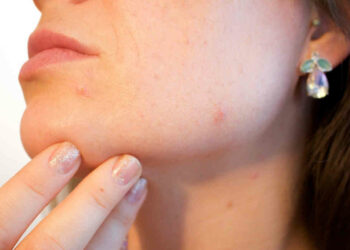 Macchie della pelle: 10 rimedi naturali