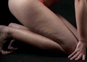 Cellulite: cosa funziona davvero per eliminarla?