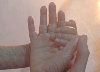 Le donne di Scicli donano a Yassine una seconda pelle: bambino con ittiosi lamellare