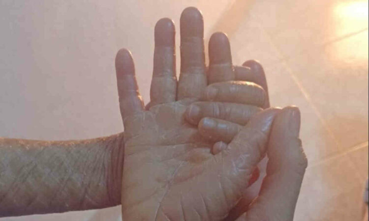 Le donne di Scicli donano a Yassine una seconda pelle: bambino con ittiosi lamellare