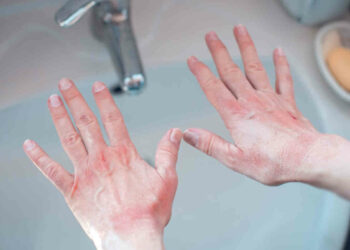 Omicron, orticaria e rash cutaneo tra i nuovi sintomi