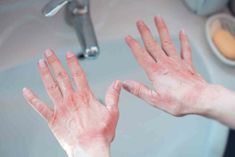Omicron, hives and skin rash among the new symptoms