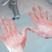 Omicron, orticaria e rash cutaneo tra i nuovi sintomi