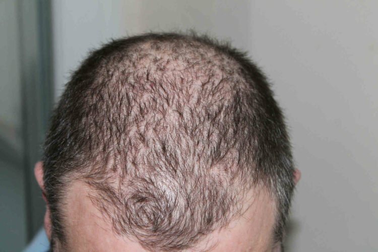 Alopecia o perdita capelli, cause e dieta: cosa mangiare