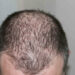 Alopecia o perdita capelli, cause e dieta: cosa mangiare