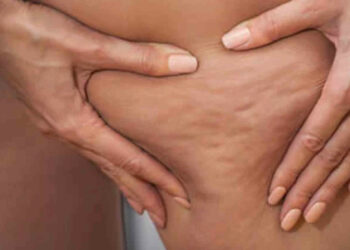 Eliminare la cellulite con 7 rimedi naturali