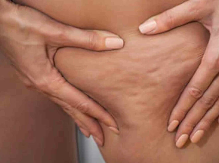 Eliminare la cellulite con 7 rimedi naturali