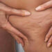 Eliminare la cellulite con 7 rimedi naturali
