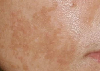 Macchie scure sul viso: problema estetico e problema ormonale