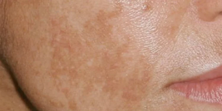 Macchie scure sul viso: problema estetico e problema ormonale