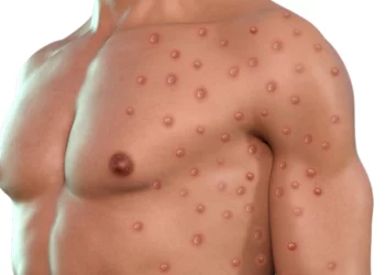 Vaiolo delle Scimmie, primo caso a Napoli