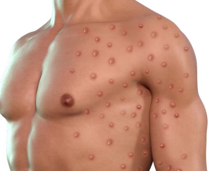 Vaiolo delle Scimmie, primo caso a Napoli