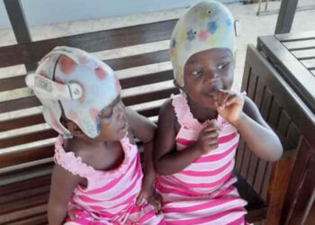 Le gemelle siamesi unite alla testa e separate da 2 anni compiono 4 anni