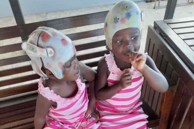 Le gemelle siamesi unite alla testa e separate da 2 anni compiono 4 anni
