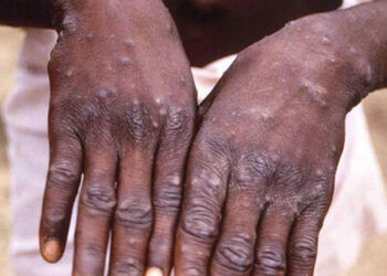 Vaiolo delle scimmie, allerta Oms: è emergenza sanitaria mondiale