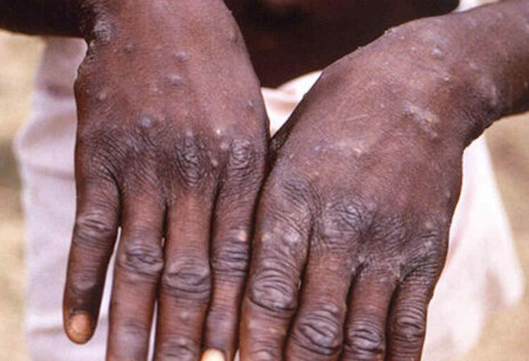 Vaiolo delle scimmie, allerta Oms: è emergenza sanitaria mondiale
