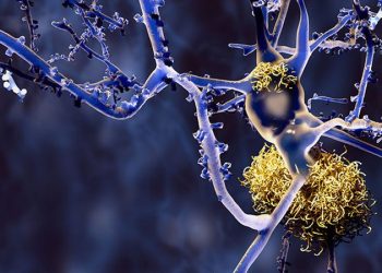 Alzheimer, Roche conferma il suo impegno in ricerca e sviluppo