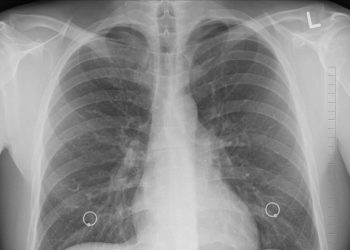 polmonite sconosciuta in argentina 3 morti