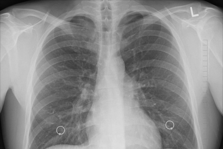 polmonite sconosciuta in argentina 3 morti