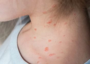 Come si prende il vaiolo delle scimmie (Monkeypox): sintomi