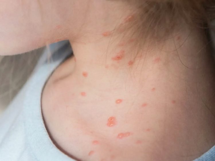 Come si prende il vaiolo delle scimmie (Monkeypox): sintomi