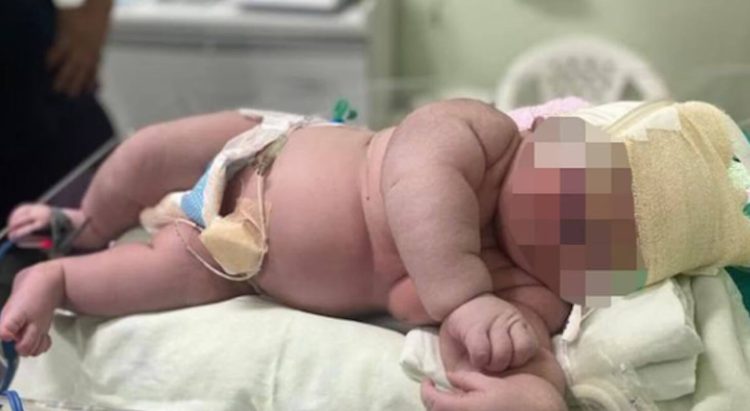 Parto record in Brasile: nato bimbo di oltre 7 chili ed è alto 60 centimetri. Il record 10 kg ad Aversa