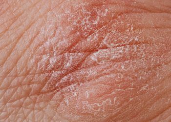 Diabete: sintomi sulla pelle