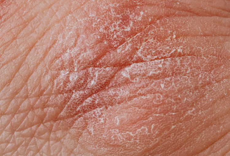 Diabete: sintomi sulla pelle